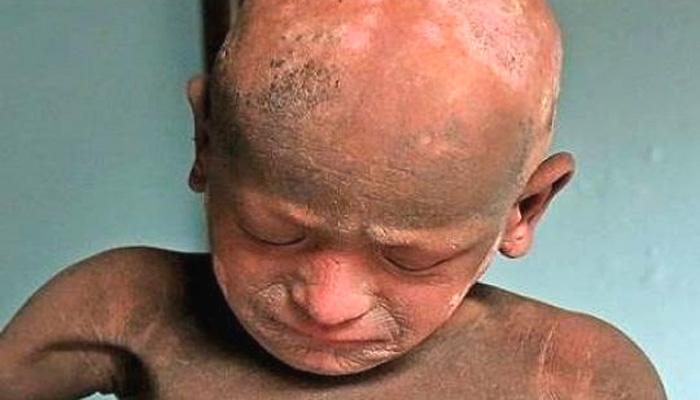 दगड बनत चाललाय हा 11 वर्षाचा मुलगा दगड बनत चाललाय हा 11 वर्षाचा मुलगा